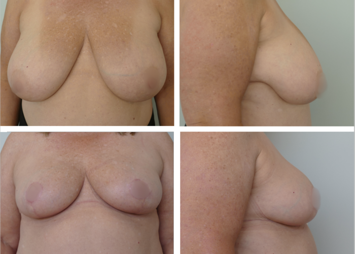 Breast Lift Portland Before and After by Dr. Tina Jenq